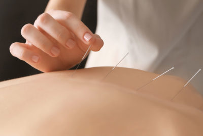 Akupunktur in der traditionellen chinesischen Medizin